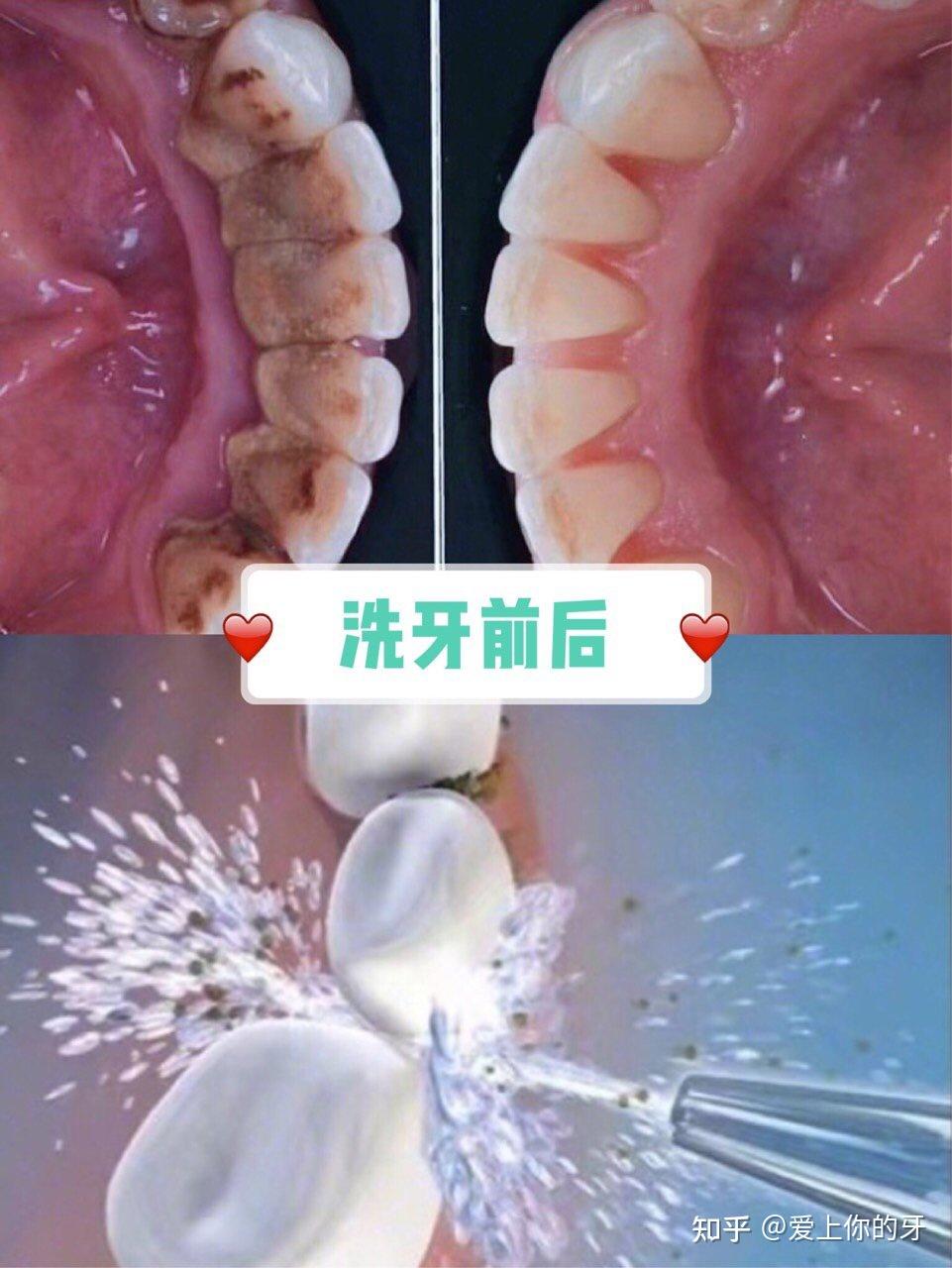 拉萨洗牙可以用医保吗(洗牙可以用医保吗,报销比例多少)